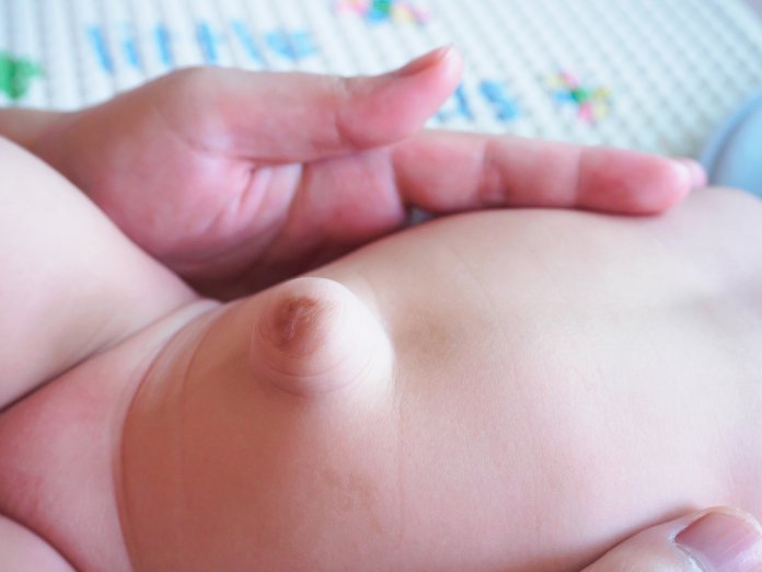 baby navel with Umbilical hernia