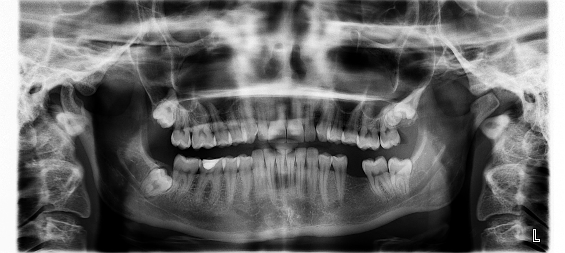 Jak wygląda RTG zęba?
